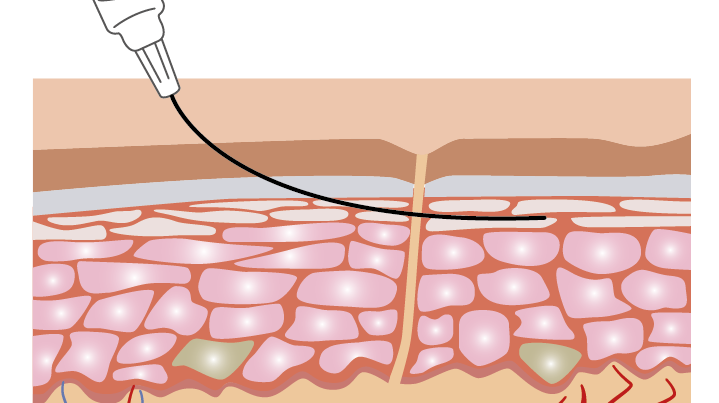 The Advantages of Micro Filler Cannulas in Facial Procedures