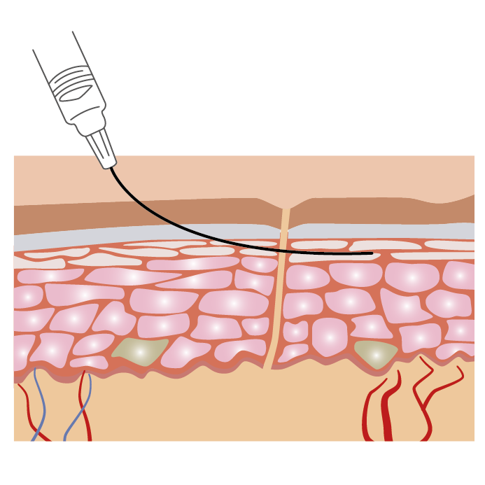 The Advantages of Micro Filler Cannulas in Facial Procedures